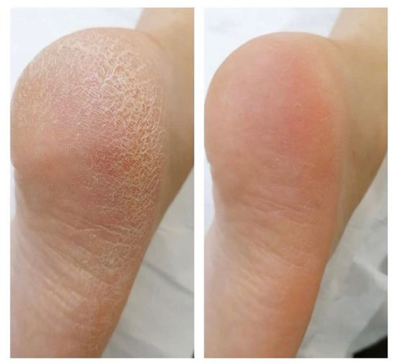 Instant Foot Peel 